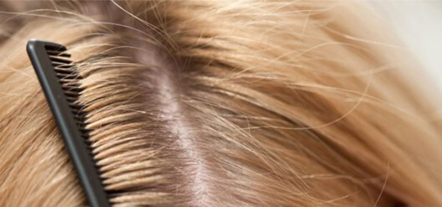 Saçlarda kepek oluşumu sebepleri nelerdir ve nasıl engellenir?