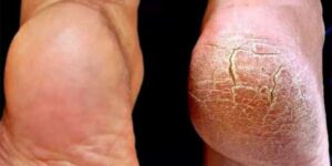 Kötü Durumda Olan Topuklarınız Adeta Pamuk Gibi Olacak