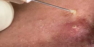 Vücut Sivilceleri: Onlardan Kurtulmak İçin 5 İpucu